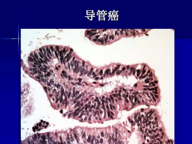 前列腺病理诊断线索（上）——黄教悌