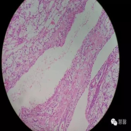 透明细胞乳头状肾细胞癌？TFE3 Traslocation Carcinoma？（赵洋分享，孔祥田(Max)*NM老师讲解）
