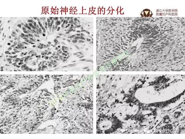 卵巢畸胎瘤诊断难点
