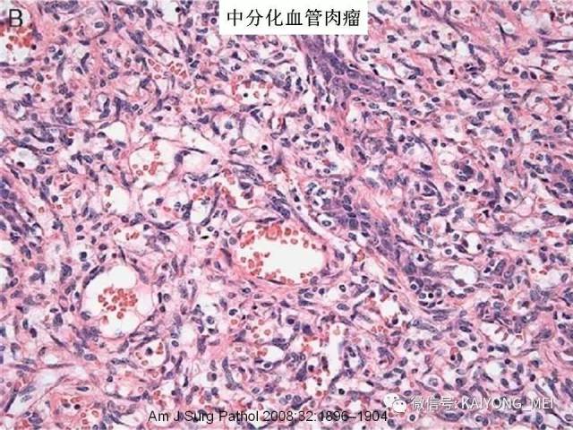 乳腺梭形细胞病变的病理诊断及进展（二）