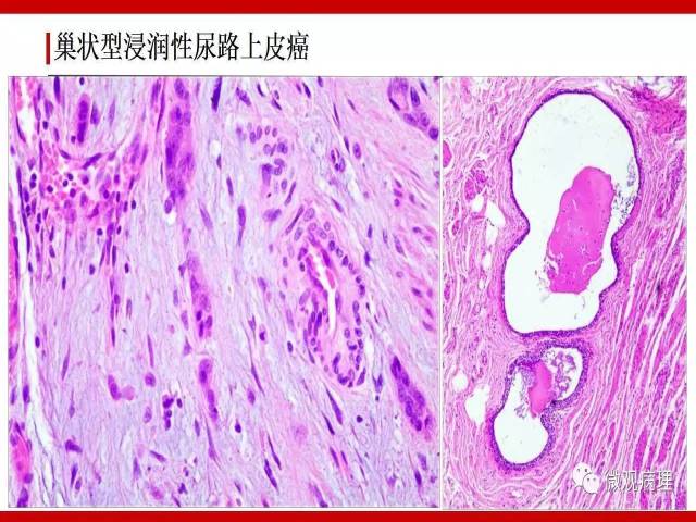膀胱尿路上皮肿瘤诊断的一些困惑