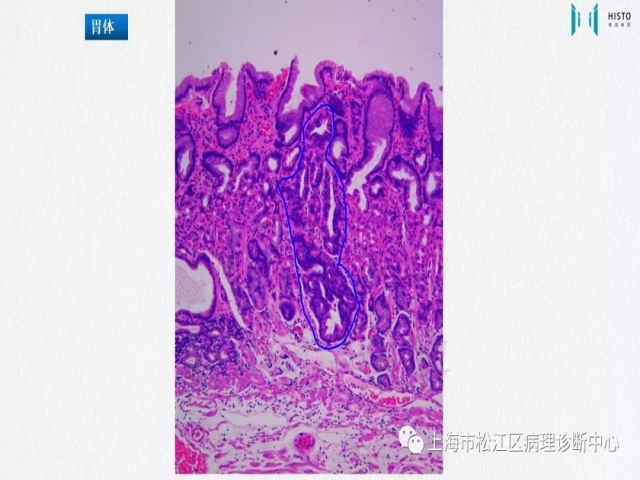上消化道早癌病理诊断中的困惑及基本对策回顾