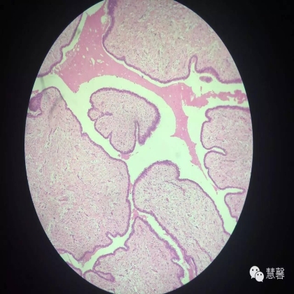 乳腺叶状肿瘤诊断（慧馨分享，孔祥田(Max)*Roswell*NM老师讲解）