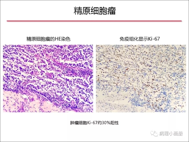 泌尿病理--精原细胞瘤VS精母细胞瘤