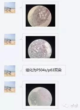 关于前列腺增生及PIN相关问题（张睿病例分享，孔祥田(Max)*Roswell*NM]老师讲解）