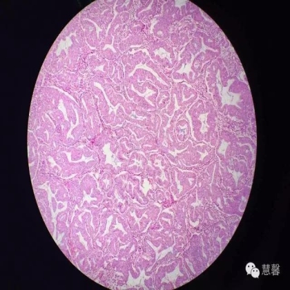 高分化子宫内膜样癌与分泌期子宫内膜、黏液腺癌的鉴别（孔令英分享，刘从容老师讲解）