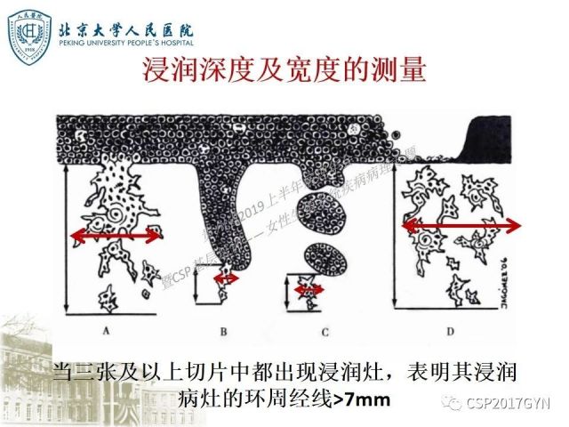 中华病理学会基层培训遵义站讲座（三）——宫颈鳞状上皮病变的病理诊断与鉴别诊断