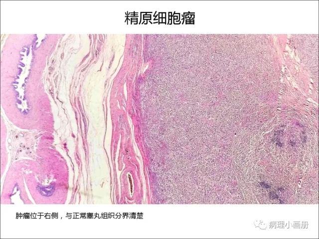 泌尿病理--精原细胞瘤VS精母细胞瘤