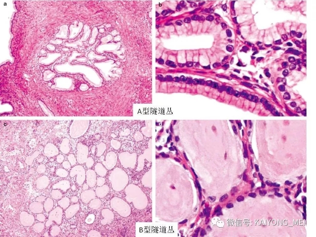 宫颈腺性病变的病理诊断及进展（一）