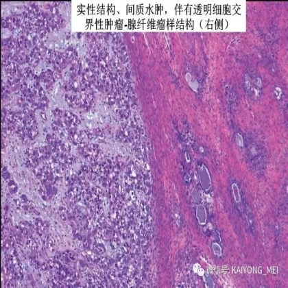 卵巢癌的病理诊断新进展（三）