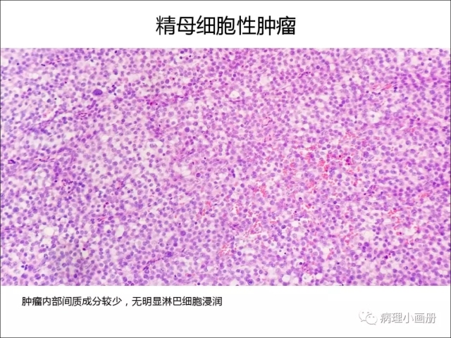 泌尿病理--精原细胞瘤VS精母细胞瘤