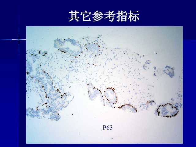 前列腺病理诊断线索（上）——黄教悌