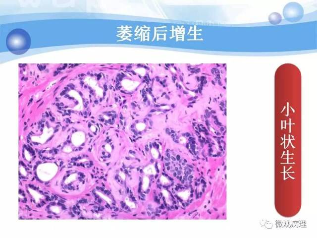 泌尿课程/局灶性前列腺萎缩