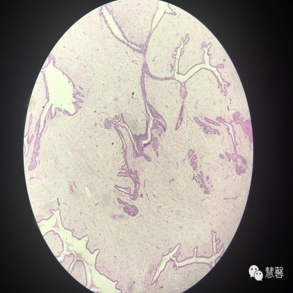 乳腺叶状肿瘤诊断（慧馨分享，孔祥田(Max)*Roswell*NM老师讲解）