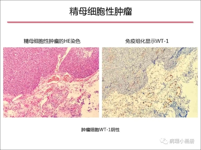 泌尿病理--精原细胞瘤VS精母细胞瘤