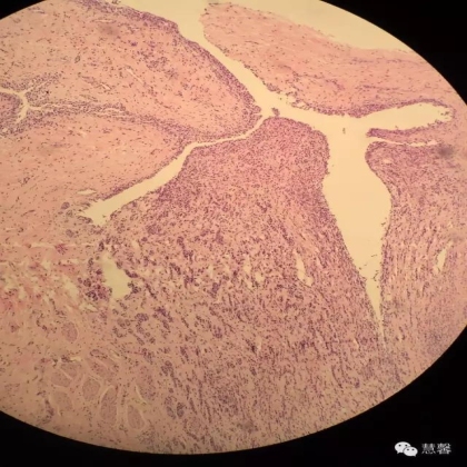 High grade nested variant Urothelial carcinoma(老胡分享，孔祥田老师讲解)