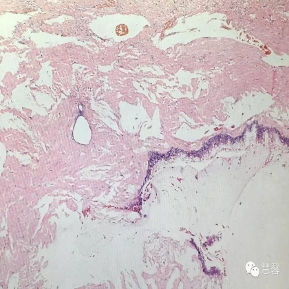 低级别黏液性肿瘤转移到卵巢伴腹腔假黏液瘤形成【小车】分享；【刘从容】老师讲解