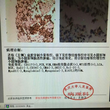 病理科新技术（二）：穿刺组织学明确诊断