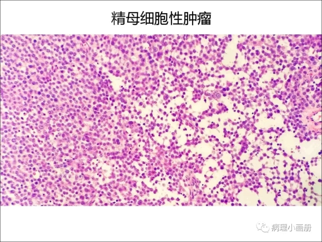 泌尿病理--精原细胞瘤VS精母细胞瘤