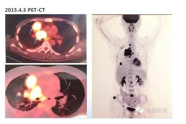 中日韩个体化诊疗案例大赛经典赏析之十四——27岁晚期NSCLC，精准治疗 与 指南盲区向左向右