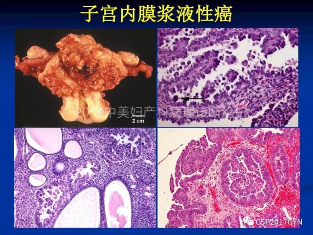 子宫内膜癌：诊断与进展