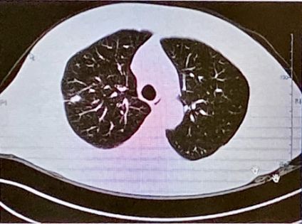 肺结节不等于肺癌！病理科医生这样说……