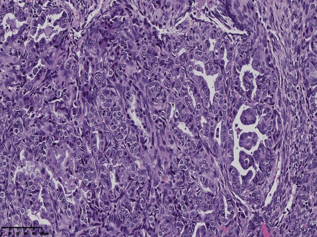 子宫透明细胞癌？