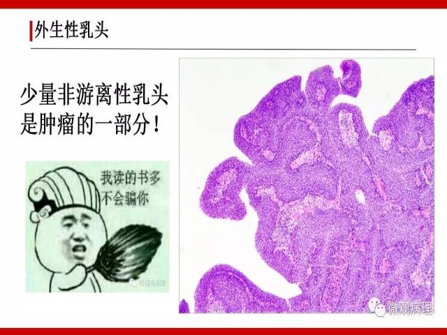 泌尿课程/非浸润性尿路上皮病变诊断的一些困惑
