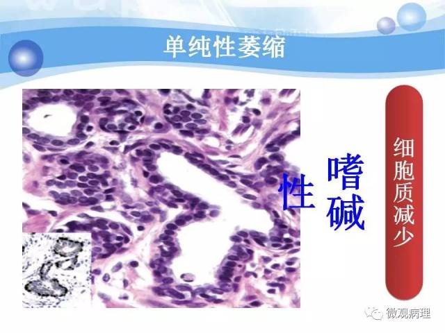 泌尿课程/局灶性前列腺萎缩