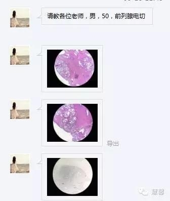 前列腺腺癌？（芳分享病例，华夏泌尿群讨论，孔祥田老师讲解）