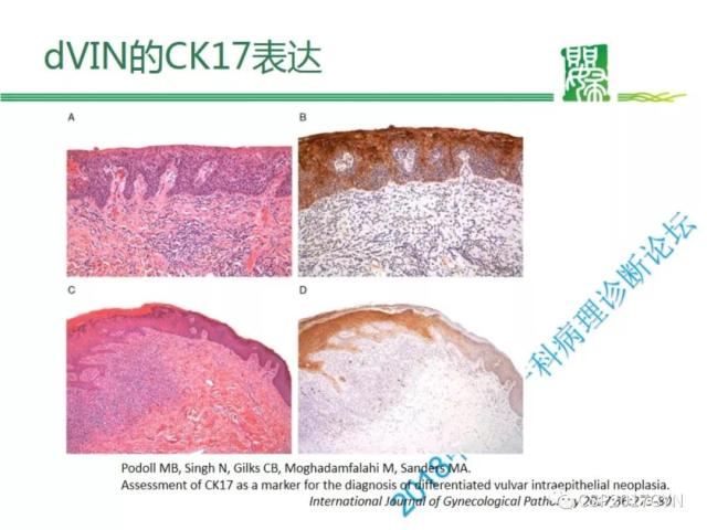非HPV相关的外阴鳞状细胞肿瘤