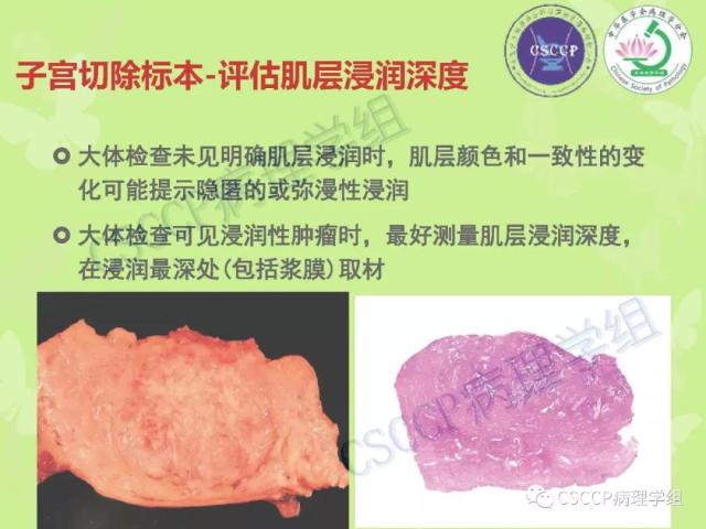 宫颈与子宫病变病理标本取材