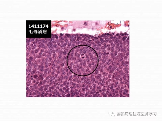 病理学基础知识 : 核分裂像的识别