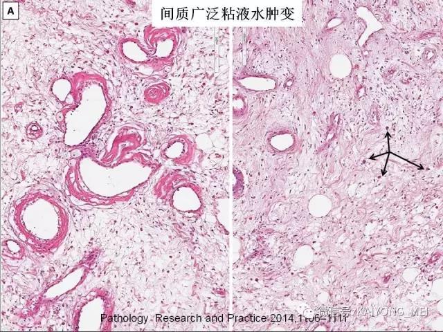 乳腺梭形细胞病变的病理诊断及进展（一）