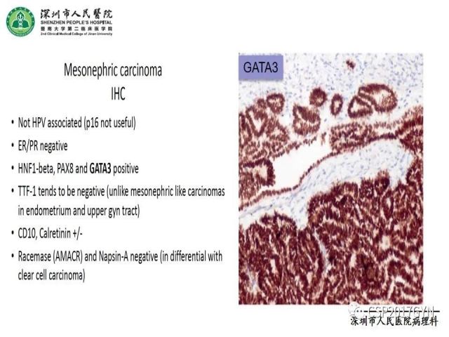 2019USCAP妇科病理热点介绍