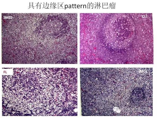 边缘区淋巴瘤（附小B细胞NHL鉴别诊断）