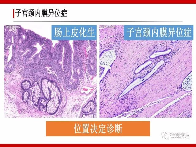 泌尿课程/尿路腺样病变的诊断要点