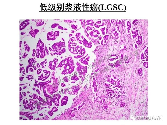 中华病理学会基层培训遵义站讲座（一）——卵巢和输卵管浆液性肿瘤的诊断和鉴别诊断