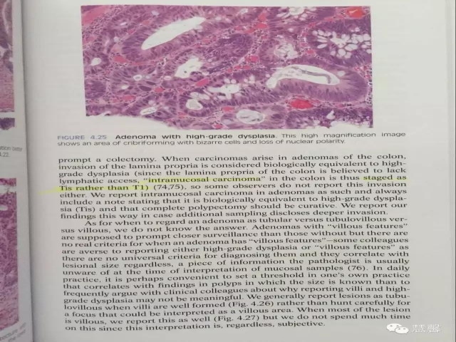 结、直肠管绒毛状腺瘤-高级别病变诊断等相关问题2（悄悄分享、孔祥田(Max)*Roswell*老师讲解）