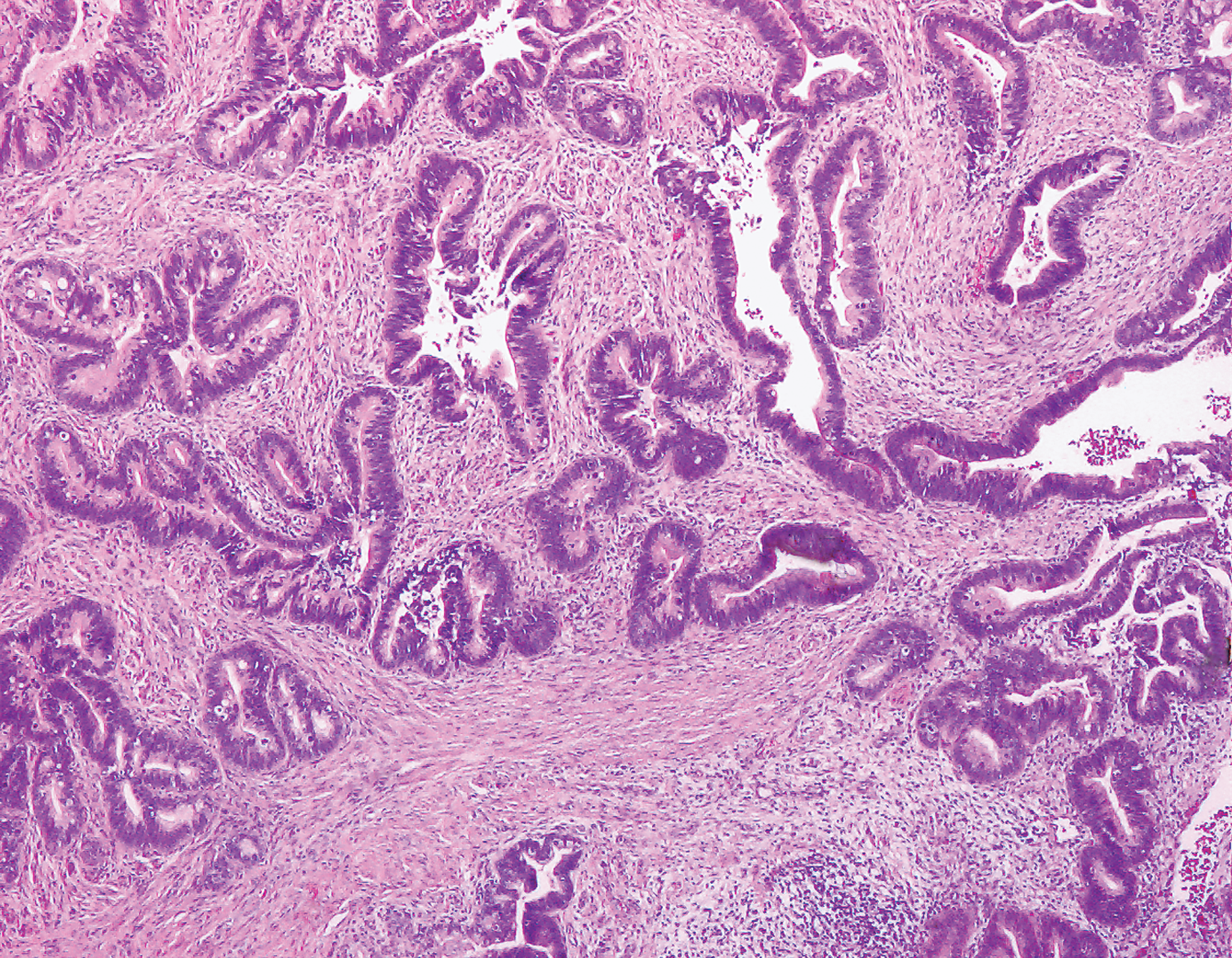 外科病理学实践：诊断过程的初学者指南 | 第16章 宫颈和阴道（Cervix and Vagina）