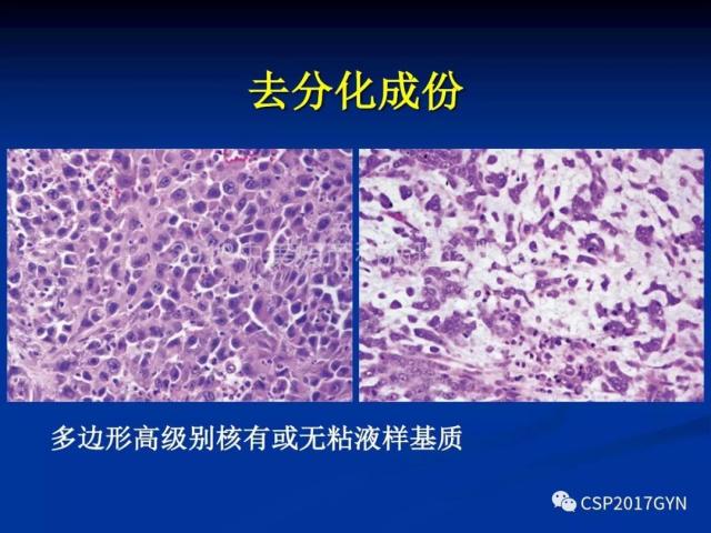 子宫内膜癌：诊断与进展