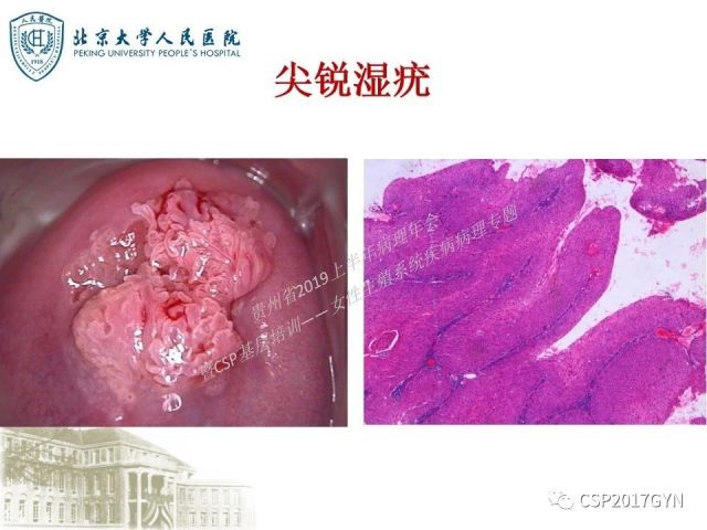 中华病理学会基层培训遵义站讲座（三）——宫颈鳞状上皮病变的病理诊断与鉴别诊断