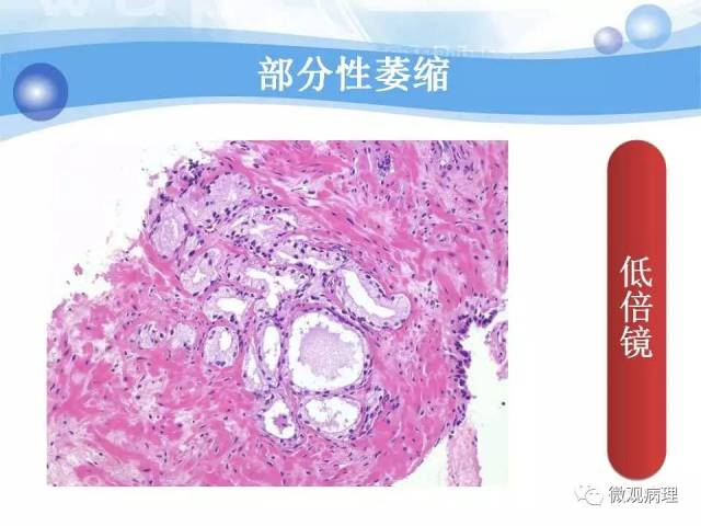 泌尿课程/局灶性前列腺萎缩