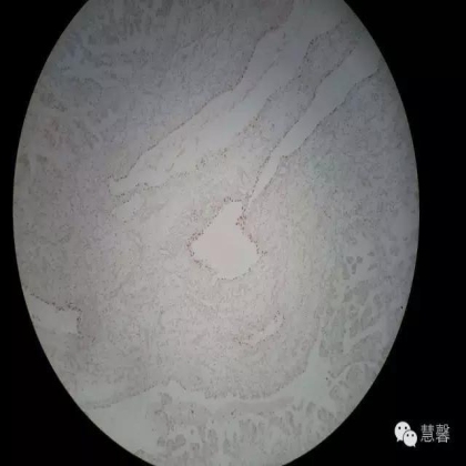 透明细胞乳头状肾细胞癌？TFE3 Traslocation Carcinoma？（赵洋分享，孔祥田(Max)*NM老师讲解）