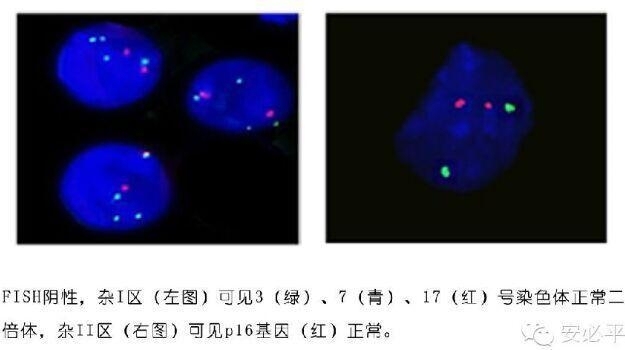 膀胱癌FISH筛查——高端体检前景广阔