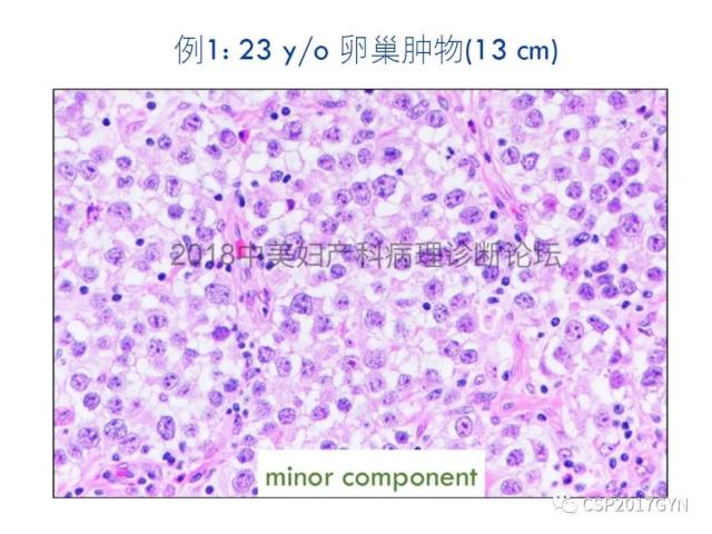 女性生殖道发育