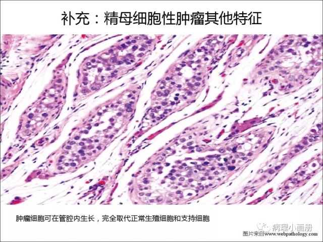 泌尿病理--精原细胞瘤VS精母细胞瘤