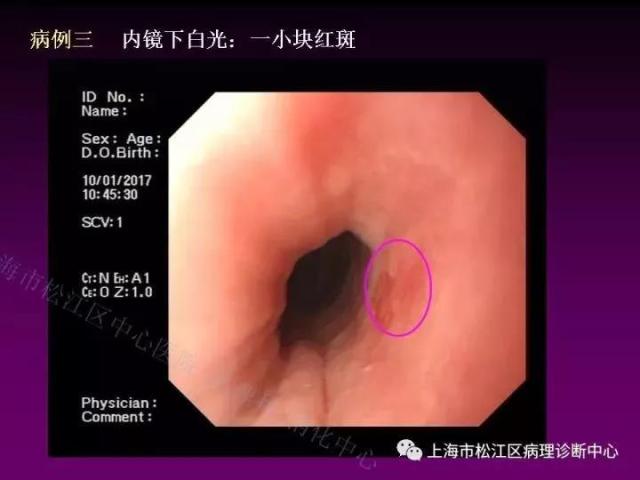 上消化道低级别上皮内瘤变的那些事