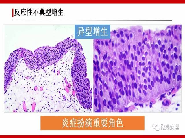 泌尿课程/非浸润性尿路上皮病变诊断的一些困惑