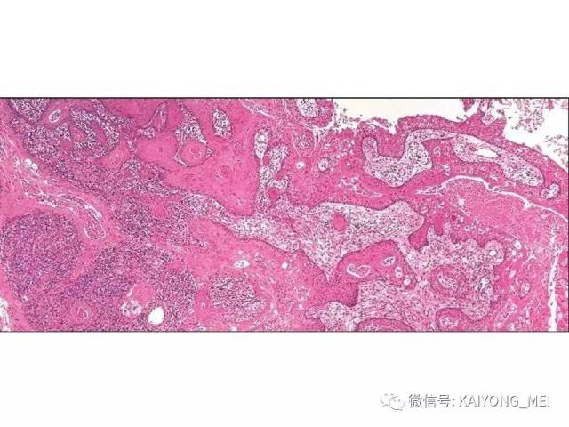 T细胞淋巴瘤病理诊断及进展（三）
